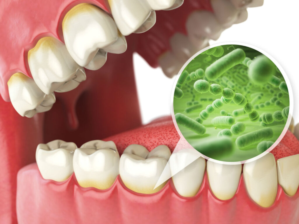 dente-bacteria-infeccao-0317-1400x1050