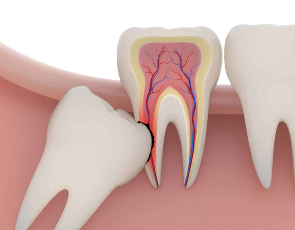 dente-juuizo-1029x800
