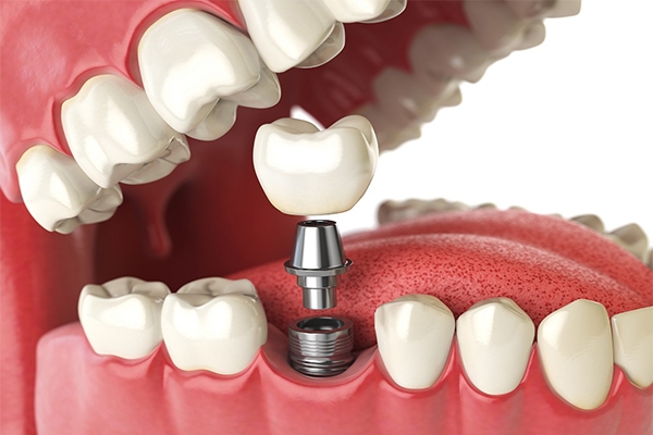 implante-dentario